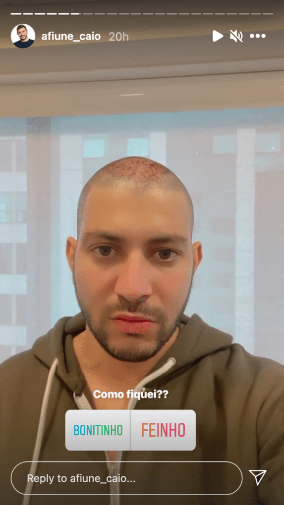 Caio apareceu careca após realizar implante (Reprodução/Instagram)