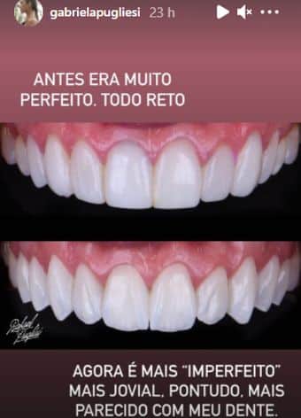 Antes e depois do sorriso de Pugliesi (Reprodução/Instagram Stories)