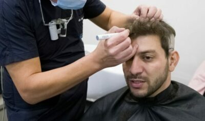 Caio Afiune realizou procedimento de implante de cabelo (Reprodução)