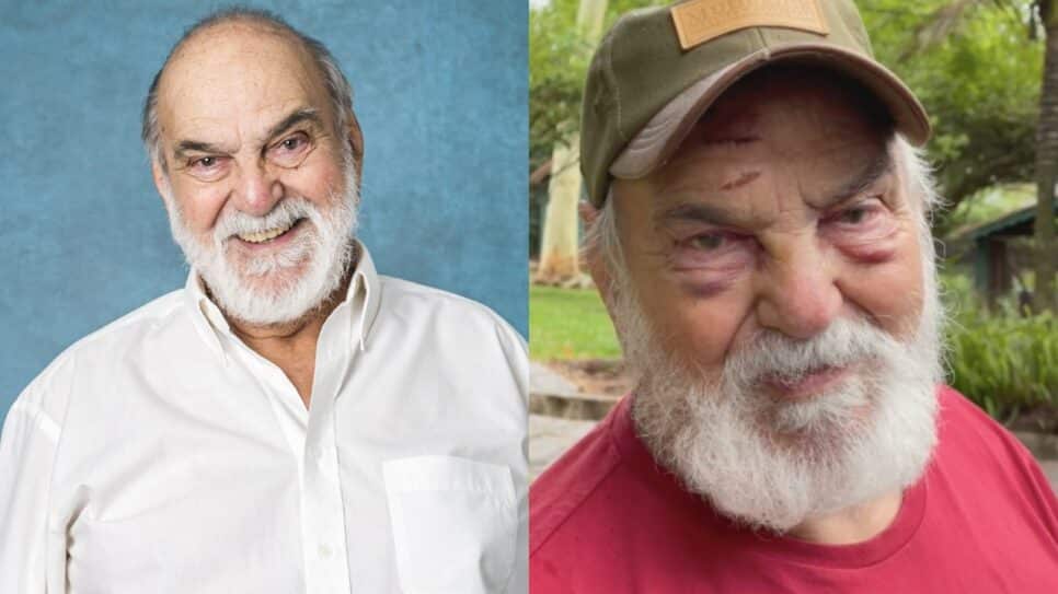 Aos 91 anos, Lima Duarte sofre acidente e surge com rosto repleto de hematomas (Reprodução)