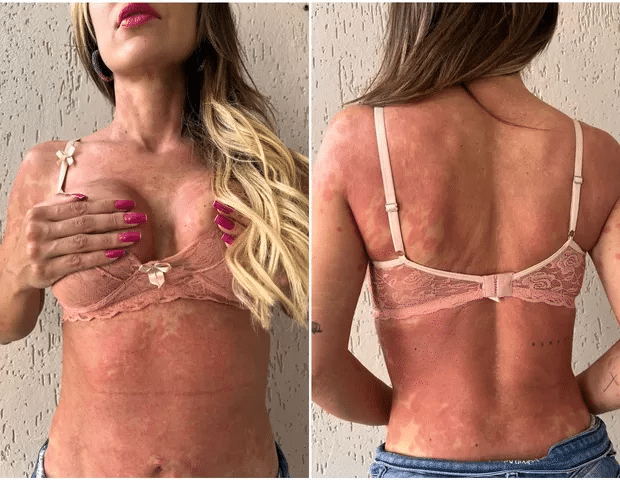 Ex-BBB é acometida por misteriosa doença (Foto: Reprodução)