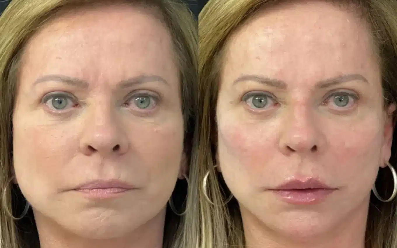 Aos 65 anos, Christina Rocha faz harmonização facial e antes e depois surpreende (Reprodução)