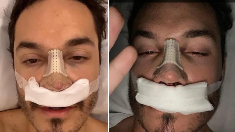 Ex-BBB Eliezer surge pós rinoplastia e revela que tirou pedaço da costela: "Quero ver", Foto: Reprodução/Internet