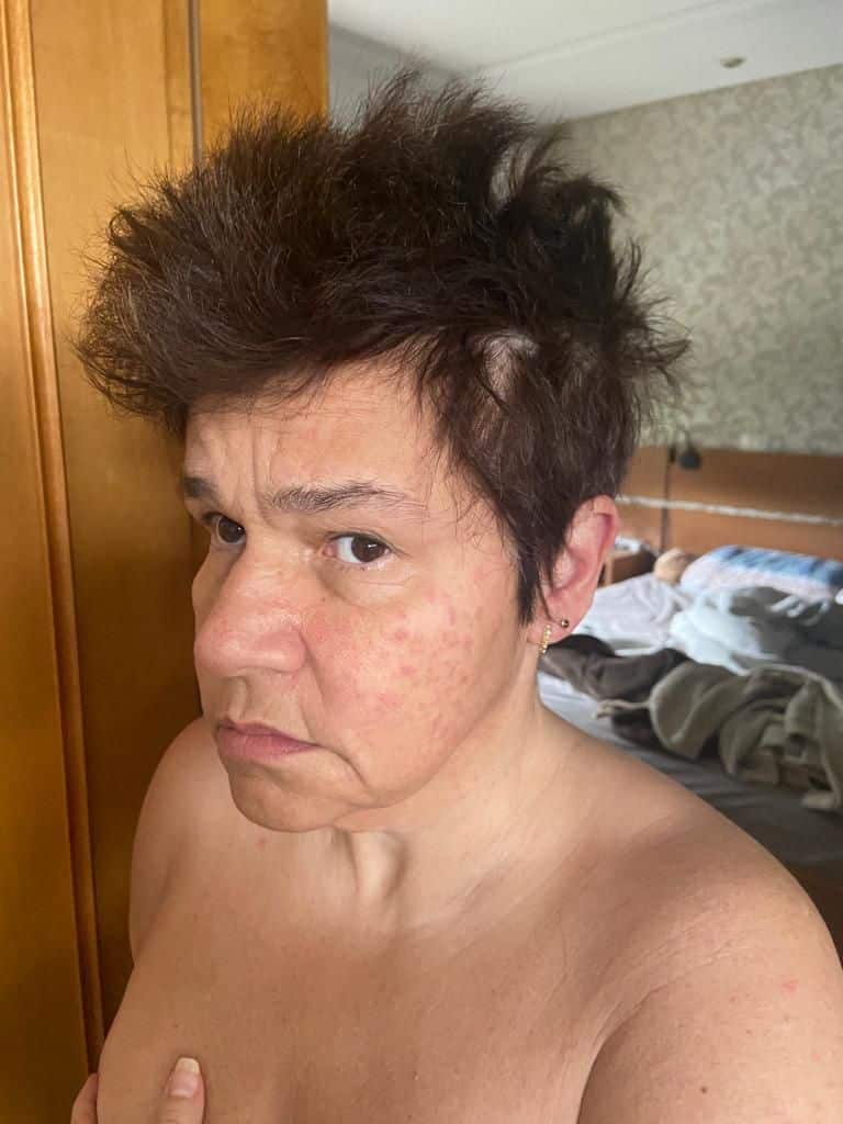 Claudia Rodrigues apresentou sintomas preocupantes e manchas no corpo e foi parar no hospital - Foto Reprodução 