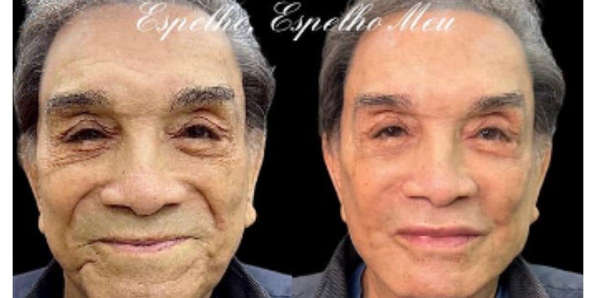 Veja antes e depois de Dedé Santana após harmonização facial