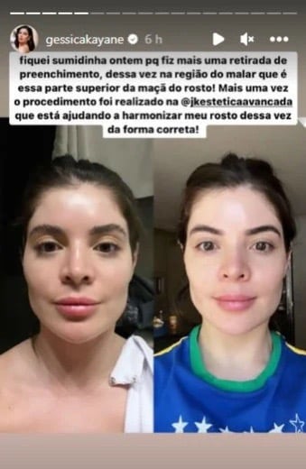 Gkay tira preenchimento e exibe antes e depois na web: 'Sem excessos'