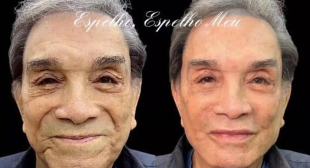 A harmonização facial de Dedé Santana teve antes e depois divulgado e dividiu opiniões na internet 