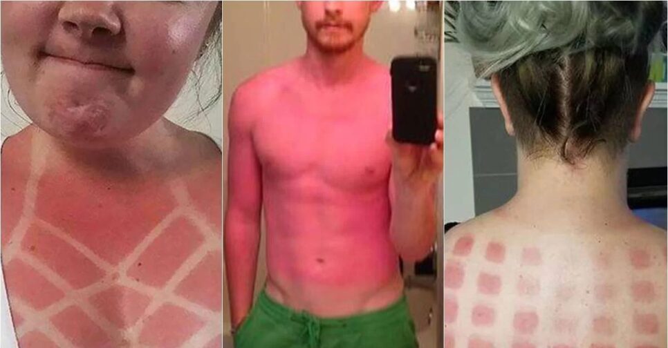 Queimadura solar é um perigo para a pele (Foto: Reprodução/ Montagem Metrópoles)