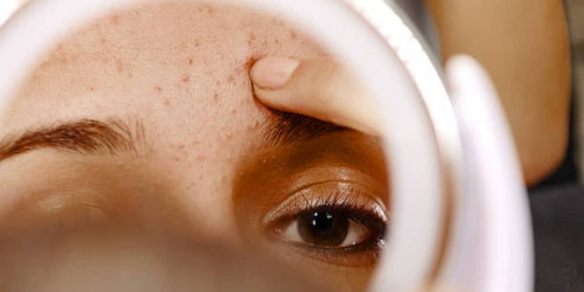 Se você sofre com a acne, faça essas infusões para melhorar a sua pele (Foto: iStock/stock_colors)