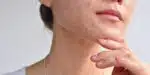 Saiba como fazer máscara caseira para evitar acnes na pele! Foto: Reprodução