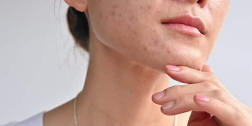 Saiba como fazer máscara caseira para evitar acnes na pele!