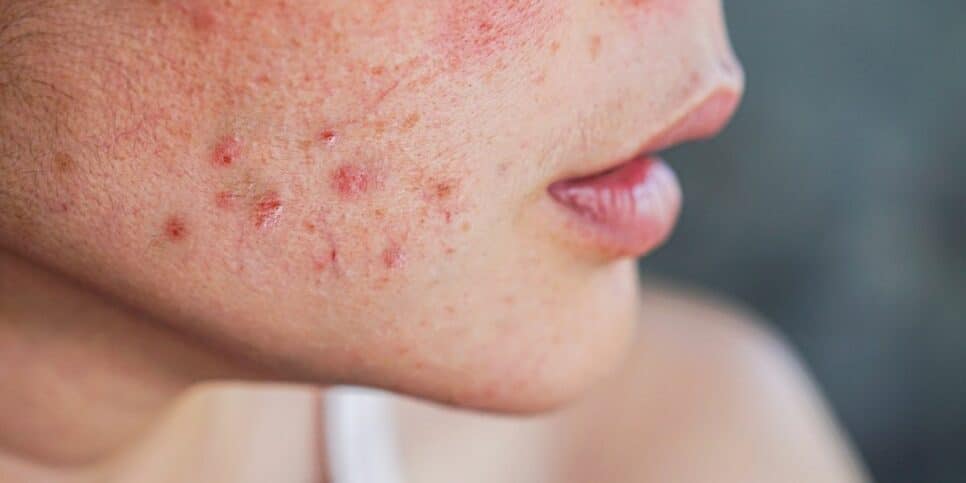Dicas caseiras para eliminar as manchas de acne do rosto (Imagem Reprodução Canva)
