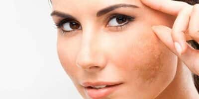 Veja o que pode ajudar nas manchas de pele e melasma (Foto: Reprodução/Internet)