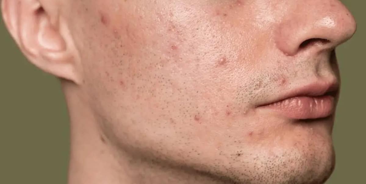 Chega de cravos e acne no rosto! RECEITA 100% natural de 3 ingredientes (Foto: Reprodução/ Freepik)