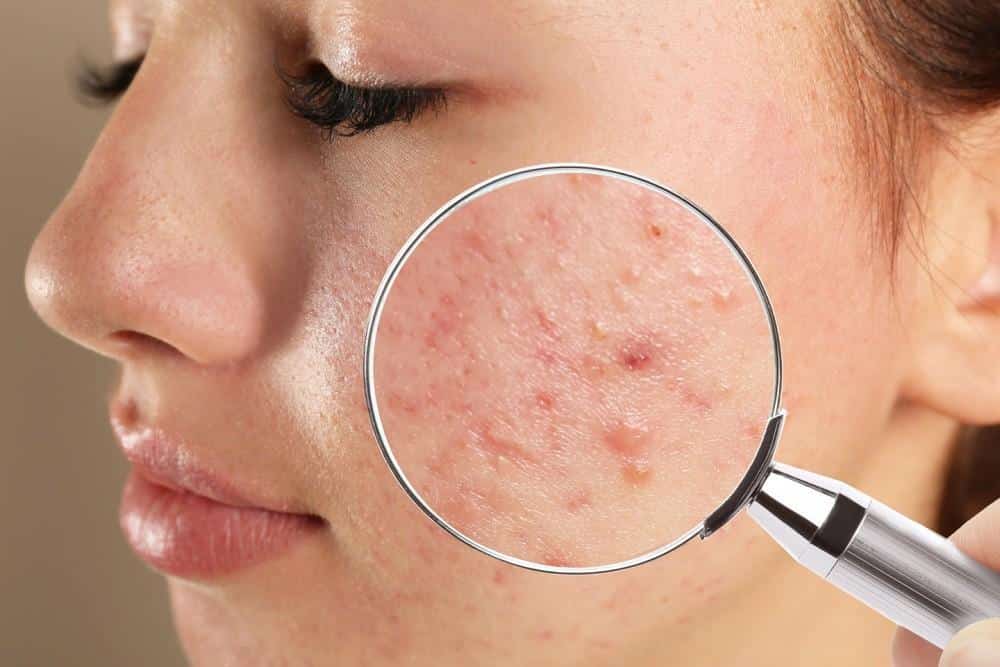 Saiba quais cuidados tomar para vencer de vez a acne feminina!