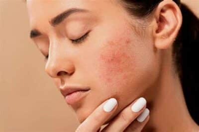 Imagem do post Saiba quais cuidados tomar para vencer de vez a acne feminina e a saúde da sua pele!