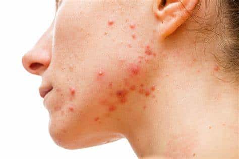 Saiba quais cuidados tomar para vencer de vez a acne e viver sem cravos e espinhas (Foto: Reprodução)