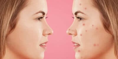 Imagem do post Zero acne! Deixe sua pele impecável e sem marcas com esses produtos naturais