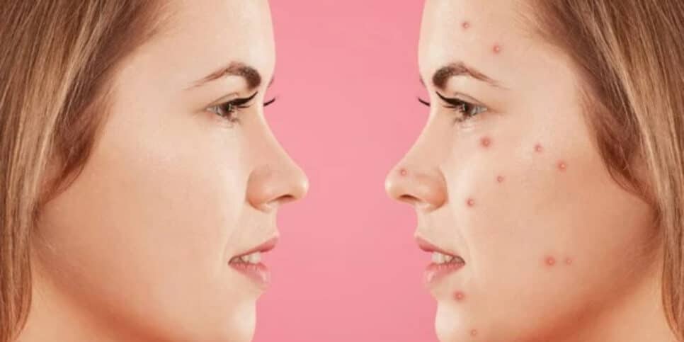 Zero acne! Deixe sua pele impecável e sem marcas agora (Foto: Sementsova321/depositphotos)