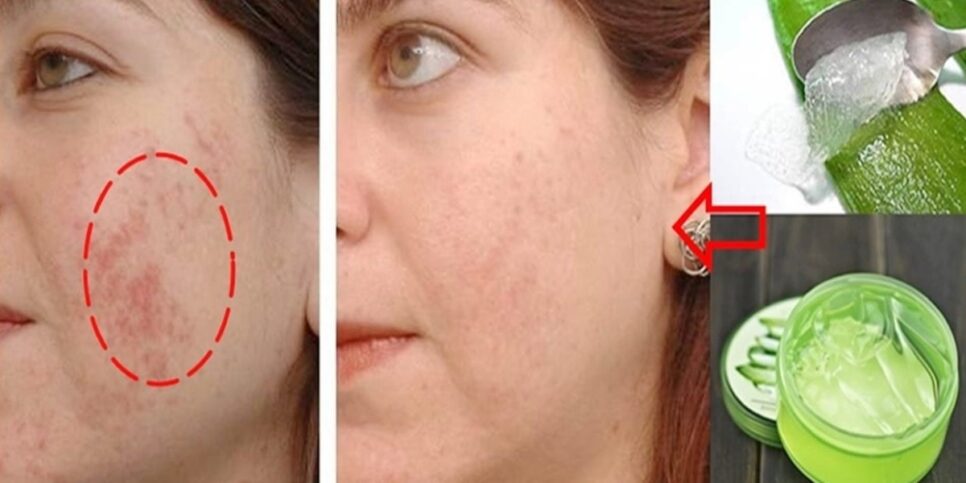 Transforme sua pele com babosa: receitas caseiras para eliminar manchas e rugas