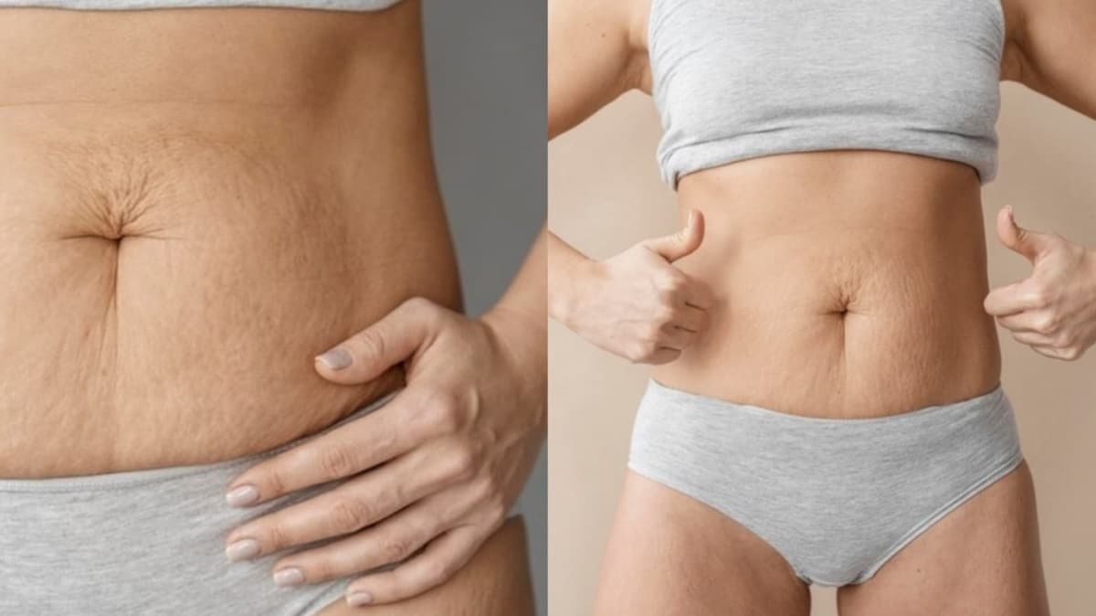 Barriga com estrias e linhas reduzidas após uso da Vitamina E (Fotos: Reprodução/ Freepik/ Montagem)