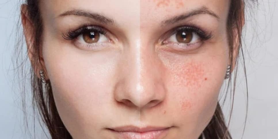 É o fim das manchas! Faça essa máscara caseira para pele (Foto: depositphotos)